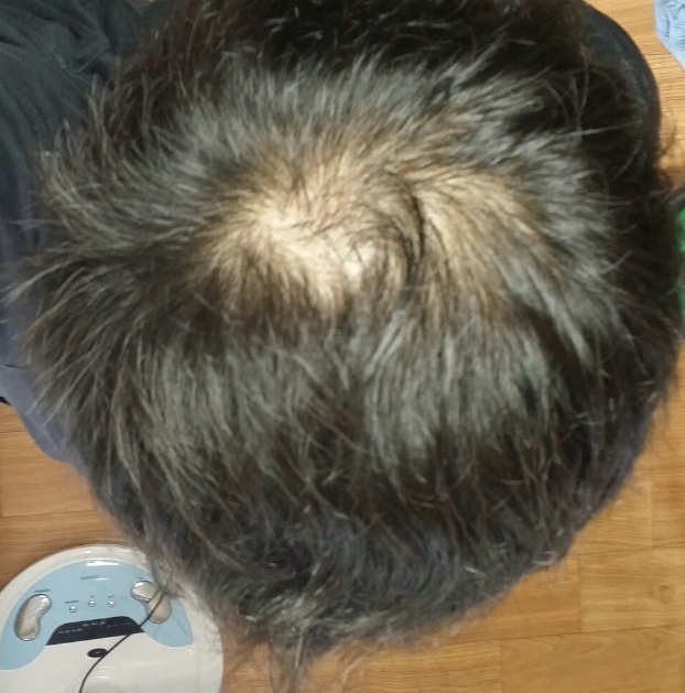 메리나정+미녹시딜 2016년8월16일 ~ 2016년11월5일 현재까지 후기입니다.