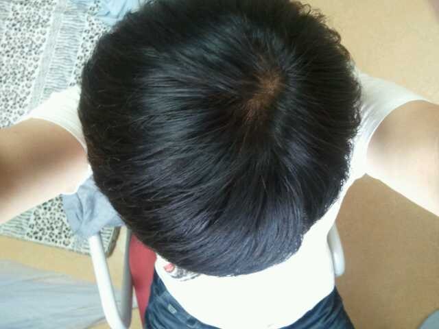 아보다트 8개월 복용기~ 다시 프페로 전환하기로 결정.