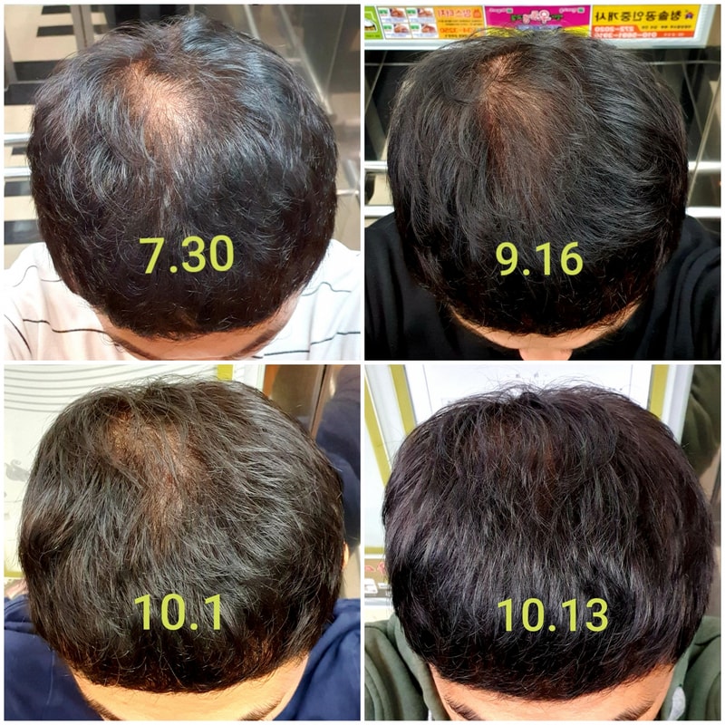 阿伏特米诺地尔两个半月后期