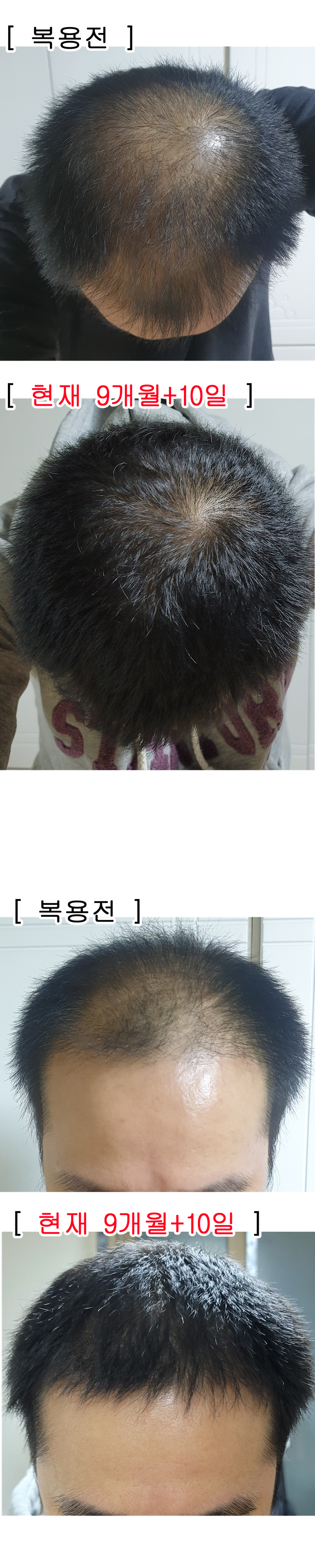 杜塔斯特里德+米诺地尔片 9个月