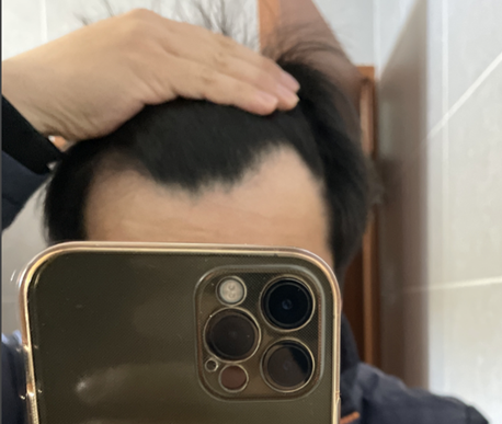 탈모약(두타) 10개월 복용중