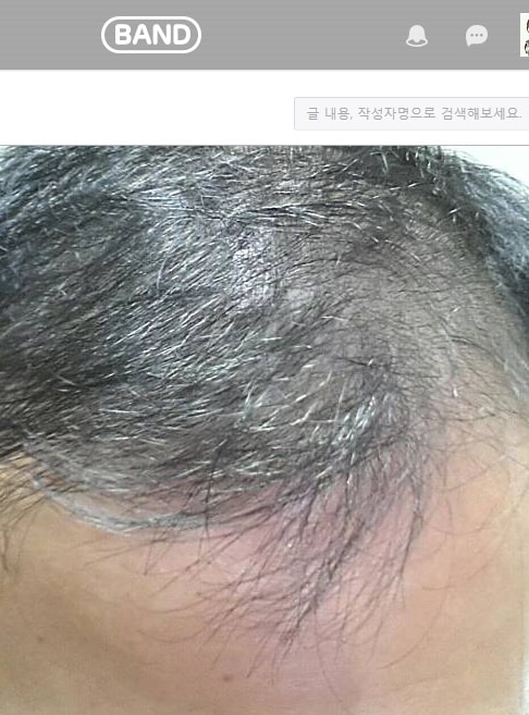 프로스카 4개월 복용 후기 !!  달라지는것 같아 뿌듯 합니다 ㅎ