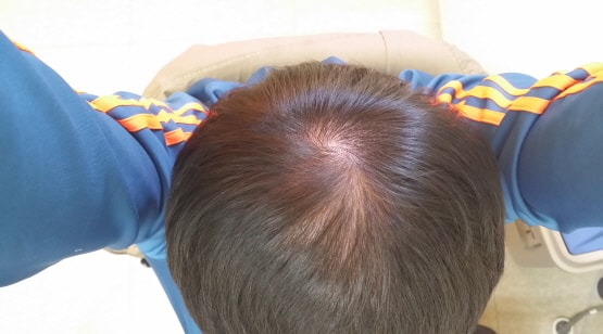 Propecia 4个月后期