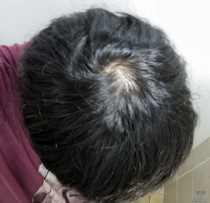 프로페시아 3개월 좀 안되게 먹은 후기 사진비교 입니다