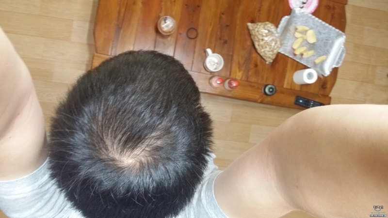 아보다트+미녹시딜 1년2개월차 후기