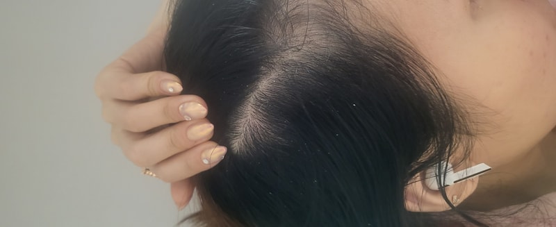 Minoxidil