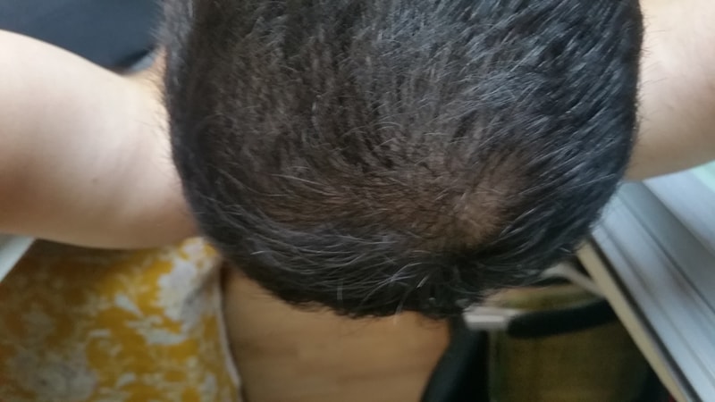 프로페시아+미녹 9개월차