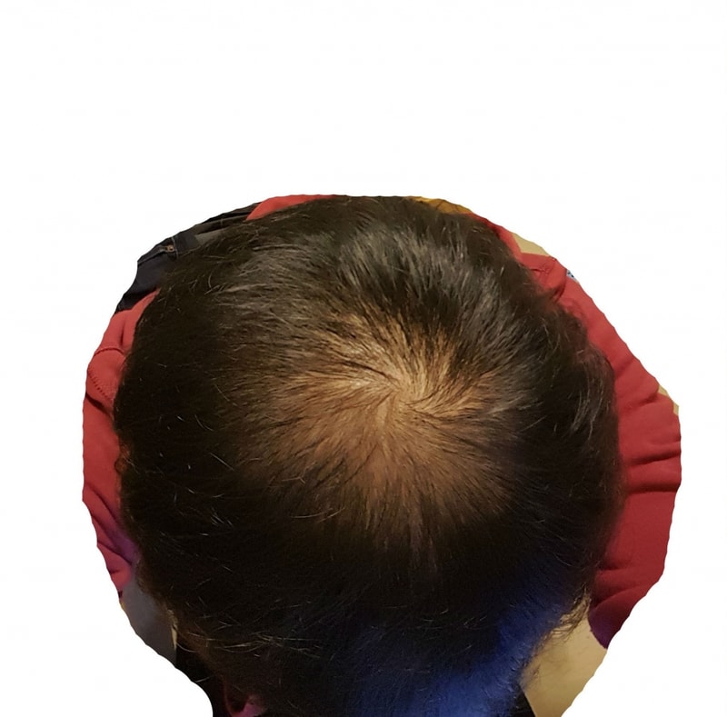 피나스테리드 + 로게인폼 9개월차 (정수리 탈모)