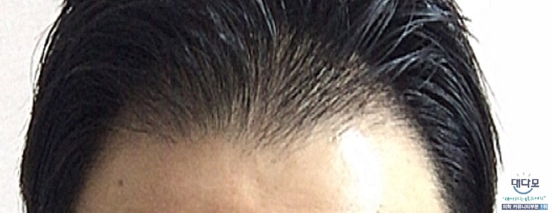 Propecia + Minoxidil 83rd Day