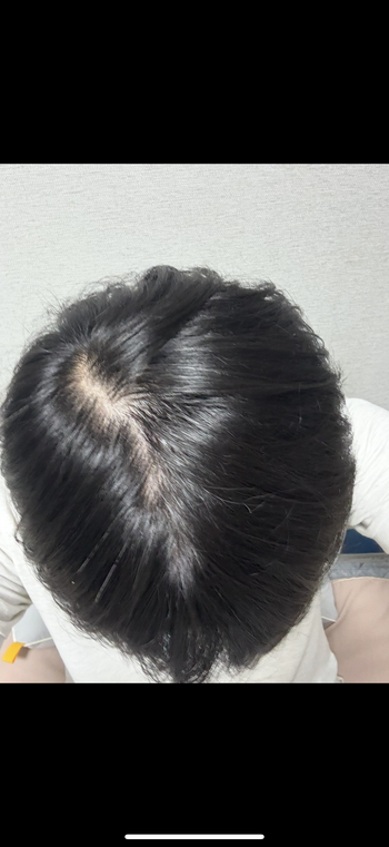 비포