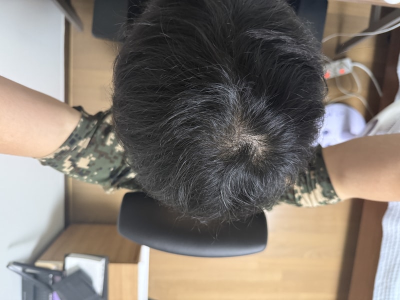 피나스테리드 8개월차
