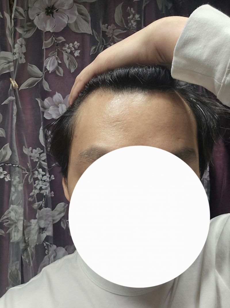 미녹시딜 2개월 차