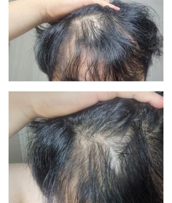6개월전 쉐딩으로 머리가털리는사진입니다