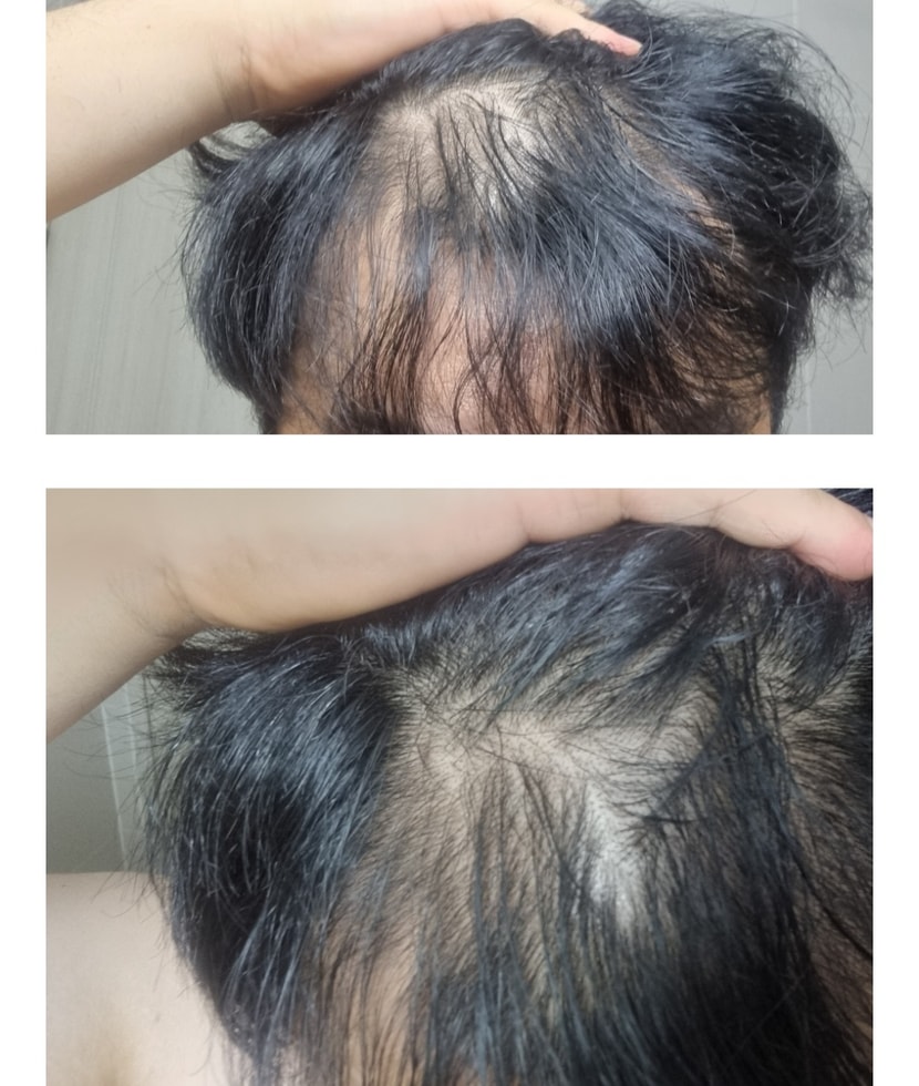 6개월전 쉐딩으로 머리가털리는사진입니다