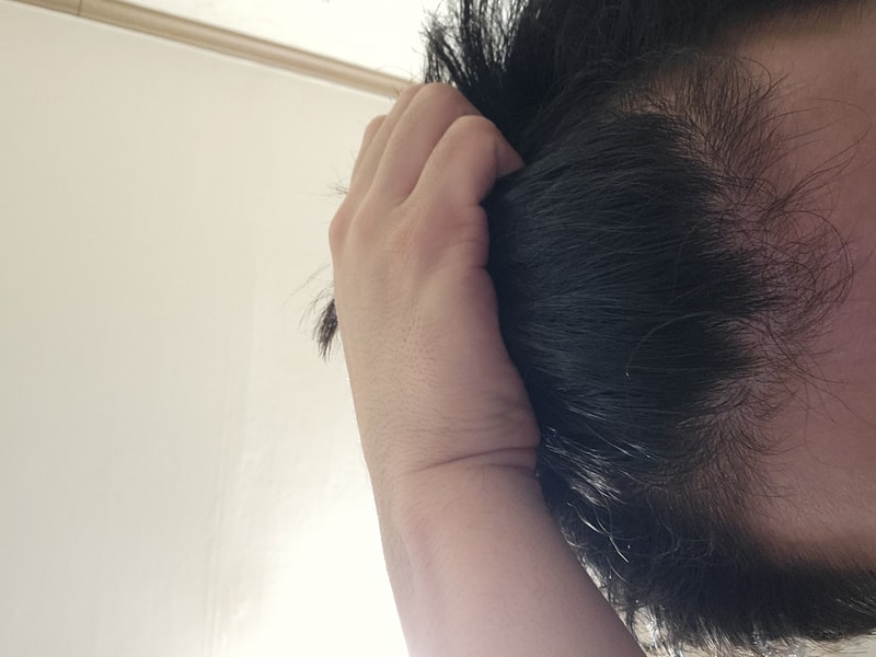 탈모약 복용 9년차