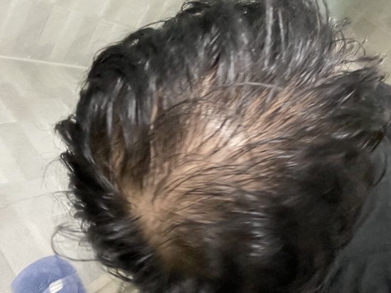 바르는약 먹는약 사용중