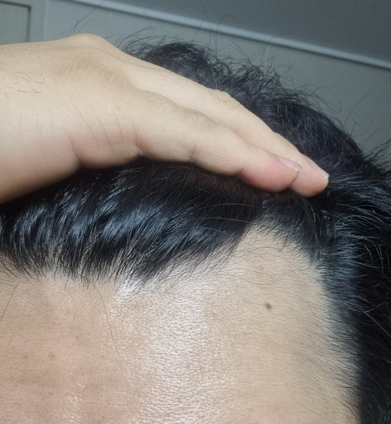 복합약 처방 백일후 애액5프로 사용후쉐딩현상