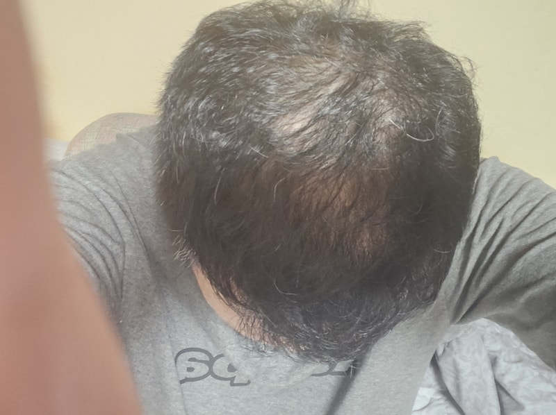 헤어그로정과 미녹시딜 반알처방