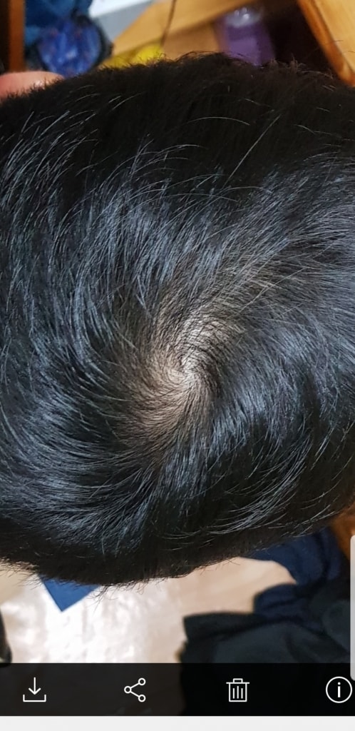 25岁 脱发约485天后期