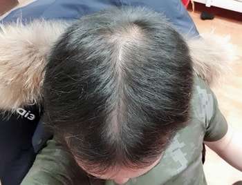 이제 약 한 45일정도 된것같습니다 꾸준히 경과올려볼게요~~