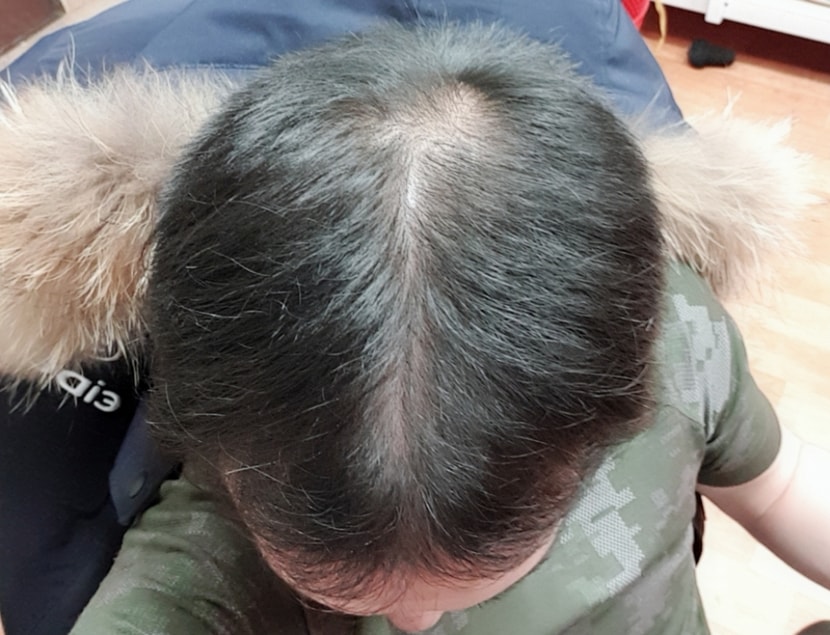 이제 약 한 45일정도 된것같습니다 꾸준히 경과올려볼게요~~