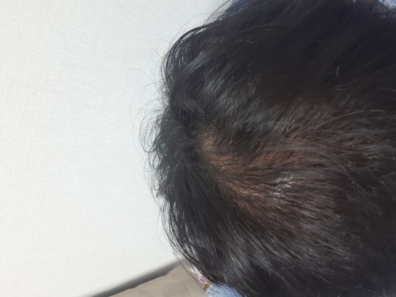 フィナ1mg モナペシア錠1mg 3ヶ月服用後の体験談