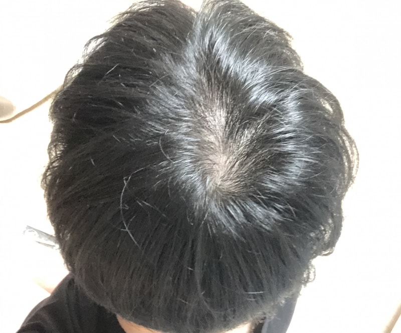 피나스테리드 3주차, 정수리+연모화+전두부