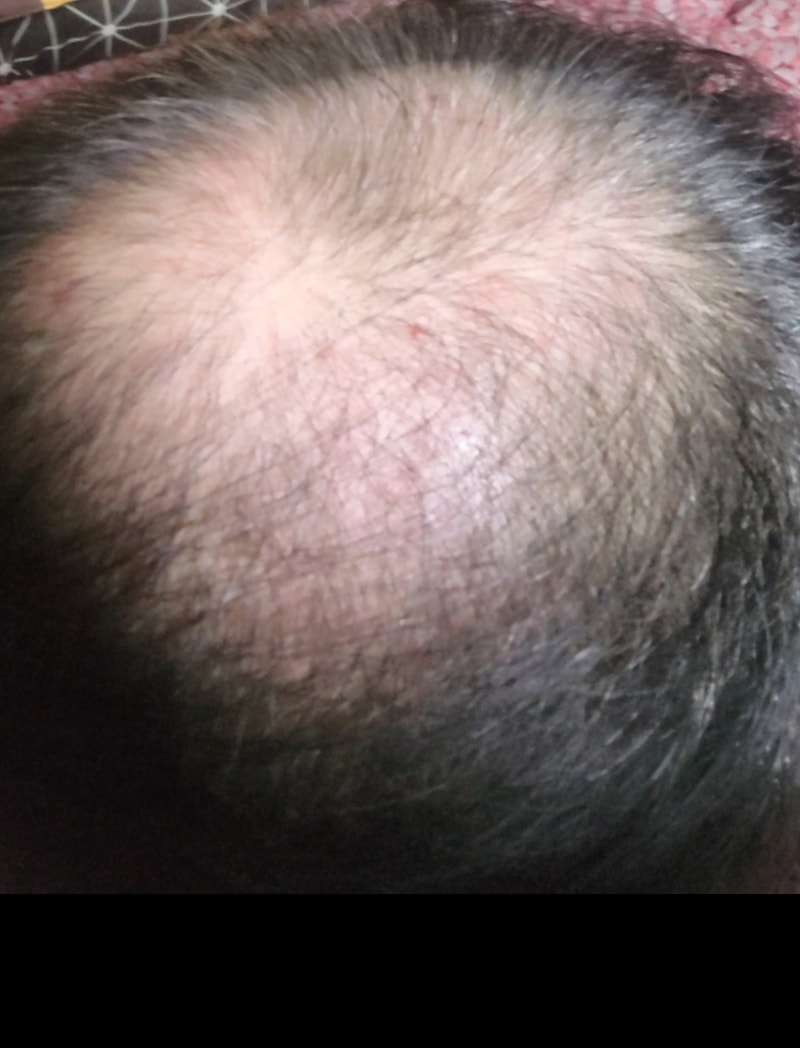 탈모약 북용1년후