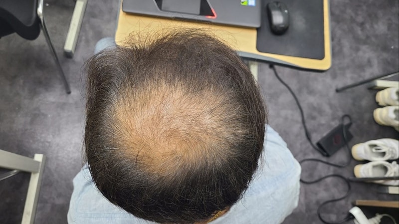 두타스테리드 복용 1년차입니다