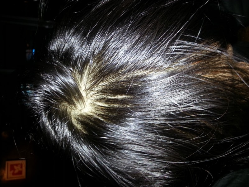 Proska 2个月+Damodart 10个月+Minoxidil+毛发移植 1年后期 有很多照片