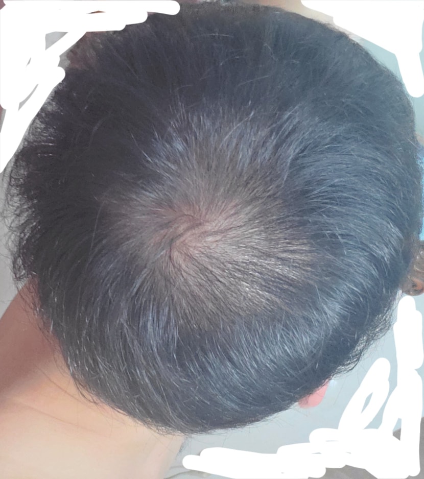7월5일날 샤워후 미녹시딜  바르기전 상태