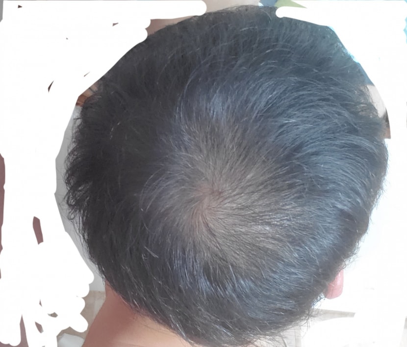 7월 28일날 샤워 후 미녹시딜 바르기전 상태