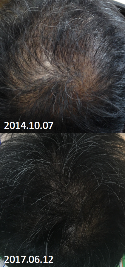 Propecia+Minoxidil 2年8个月后期(35岁后半期)