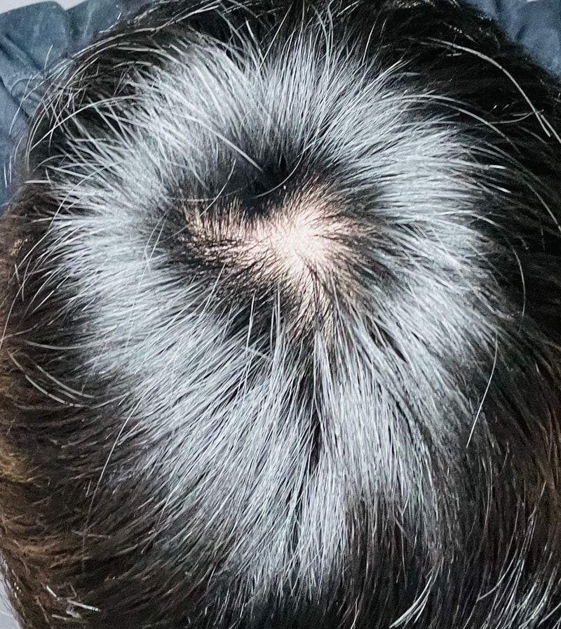 피나 복용 11일차