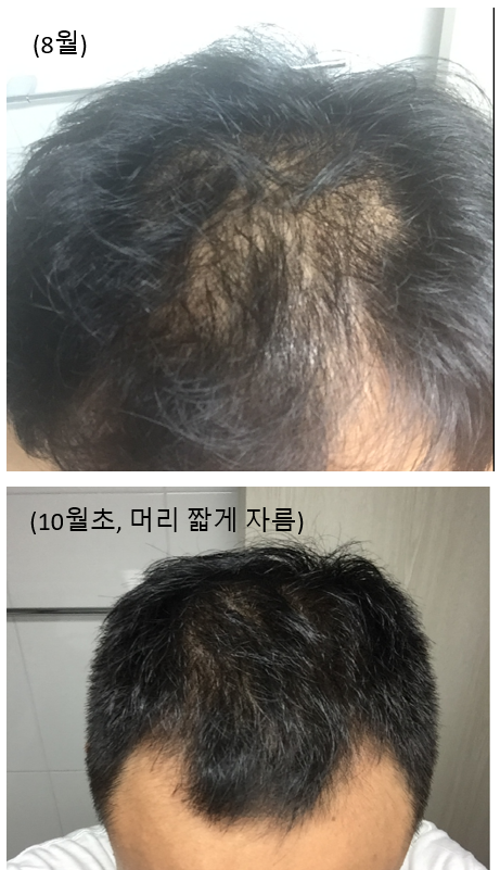 로게인 + 엘크라넬 + 판토비가 4개월 사용 후기 입니다.