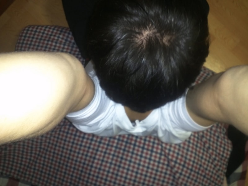 프로페시아 곧 3달 다되갑니다