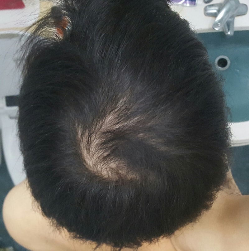 미노페시아 8개월차 (미녹시딜 2주)