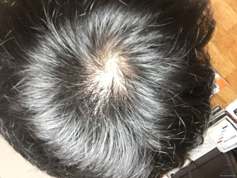 Prosca 1个月及后期