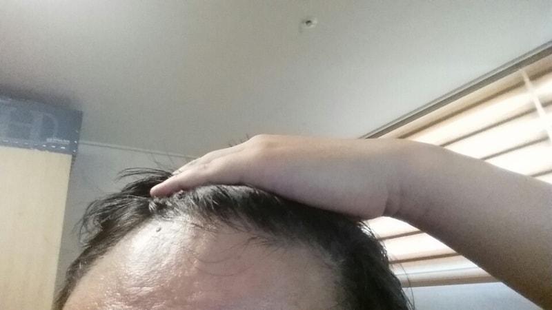 핀페시아 복용 후기