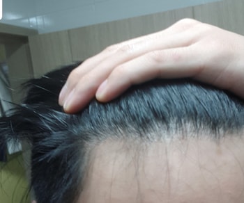 20년 1월 미녹시딜5개월차(피나/두타는 5년차) 잔머리 반대쪽