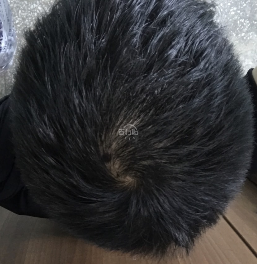 프페복용 80일차