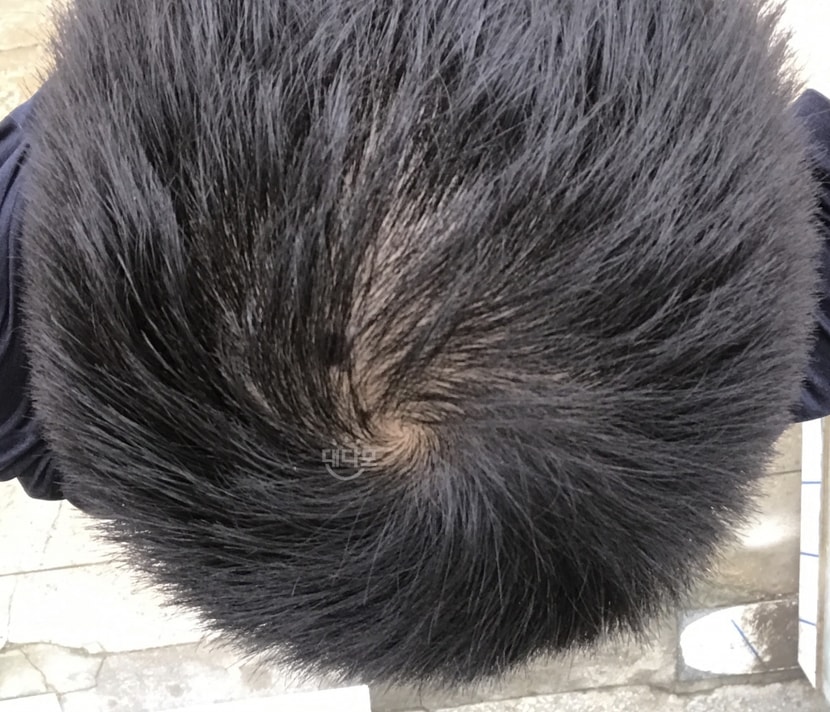 프페복용 50일차