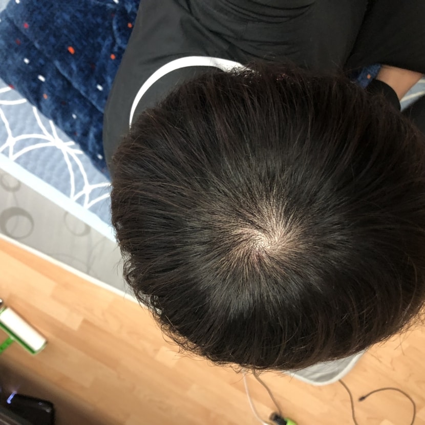 복용 1년4개월 현재