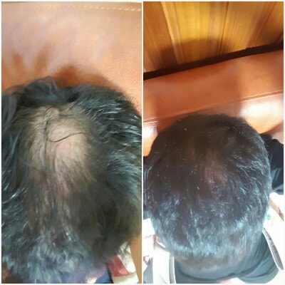 참빛의원 조합약 3개월후기