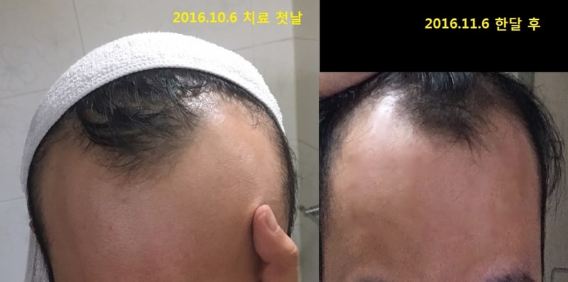 Narok+围巾+Abodote+FFCA+头皮营养剂1个月后期