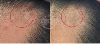 &lt;왼쪽은 먹기 전, 오른쪽은 먹은 후 2주차(그리고 미녹 한달차)&gt;