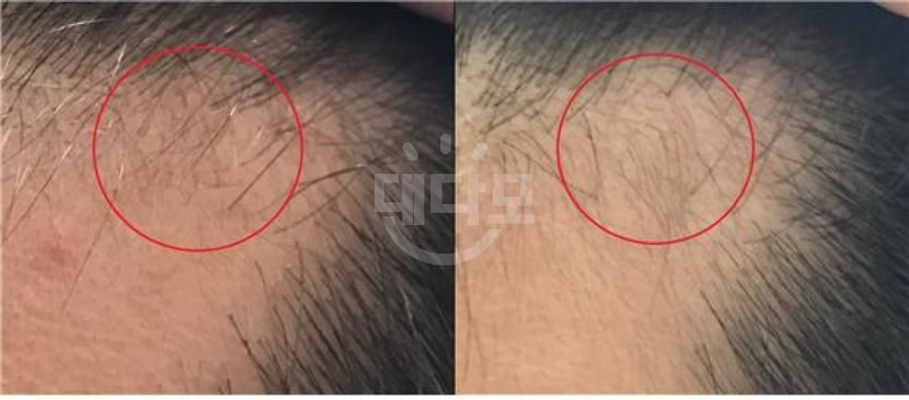 &lt;왼쪽은 먹기 전, 오른쪽은 먹은 후 2주차(그리고 미녹 한달차)&gt;