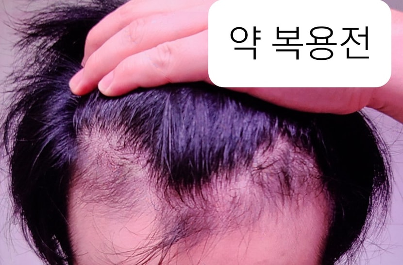 약 복용전