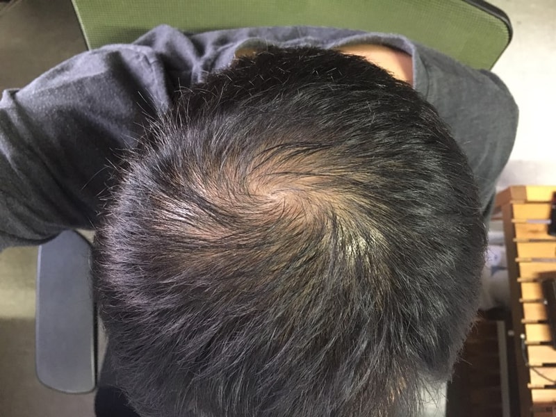 非那斯特里德3个月后期。