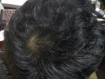 2015년12월16일 머리 깎은후 정수리 모습